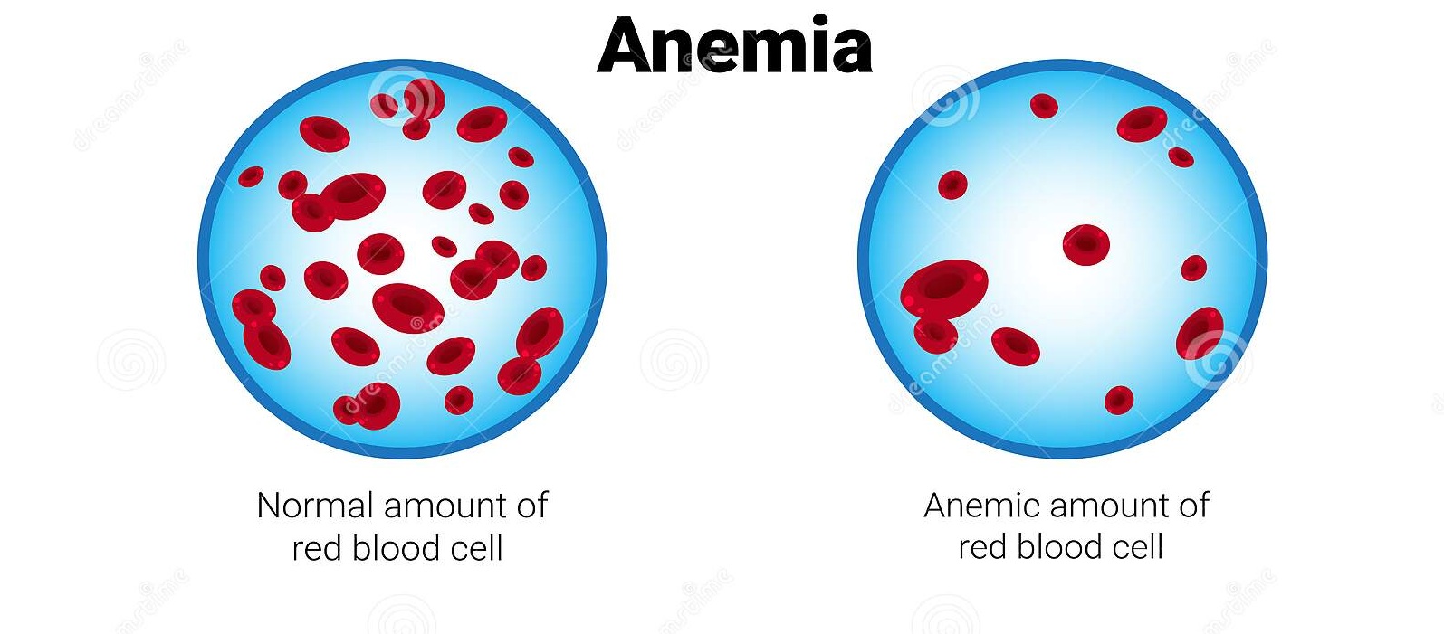 HBOT For Acute Anaemia, Exceptional Blood Loss Anameia in Aurangabad